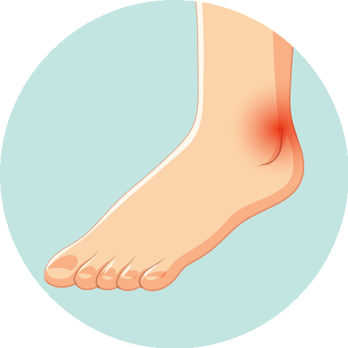Gout, Hyperuricemia 痛风、高尿酸